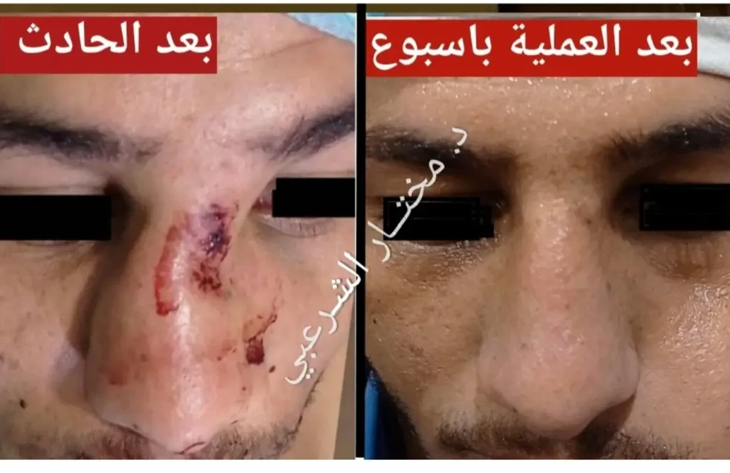 نتيجة اصلاح كسر الأنف 8