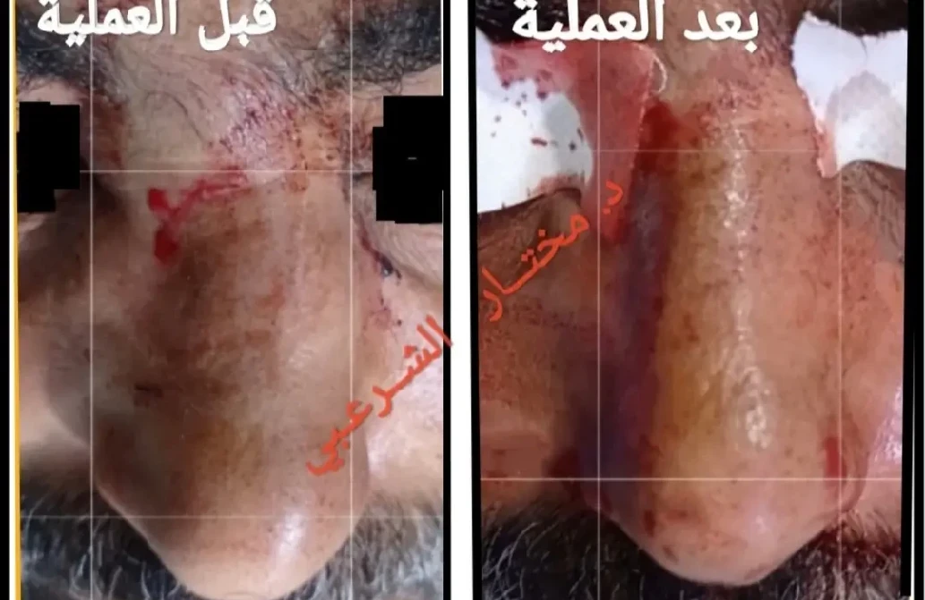 نتيجة اصلاح كسر الأنف1 7