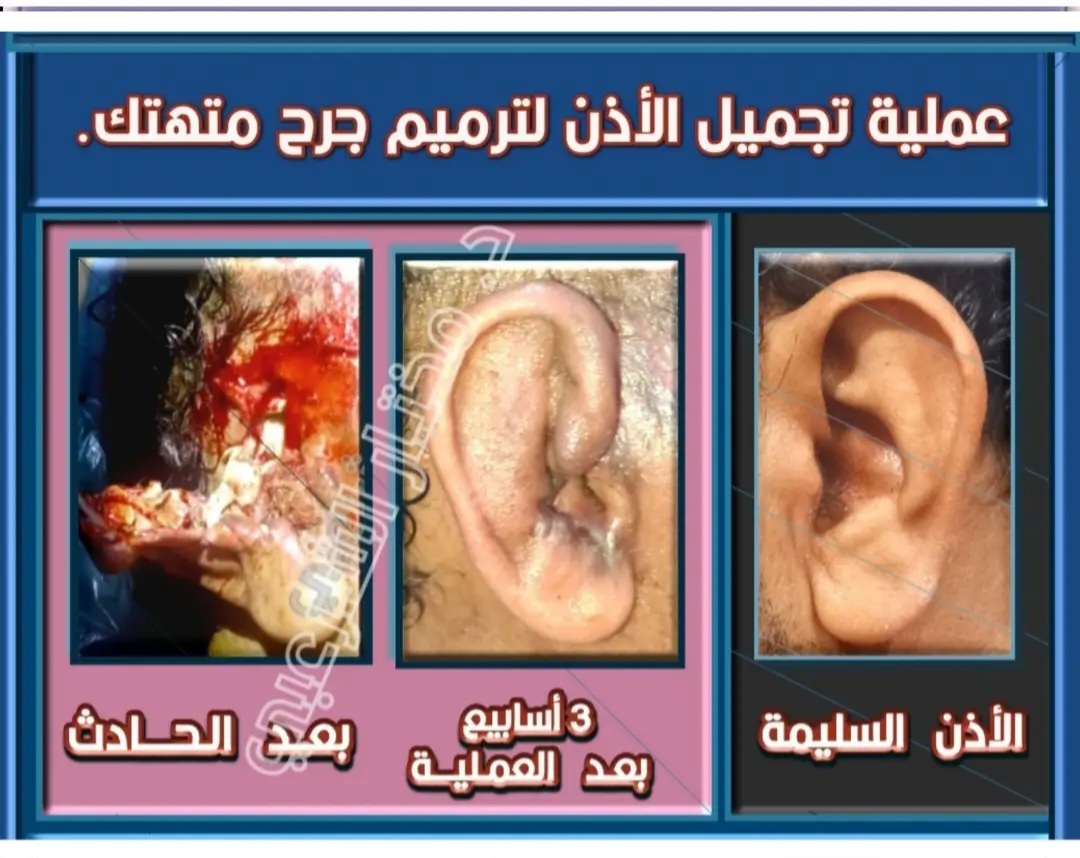 نتيجة اصلاح جراحة تجميلية للاذن 