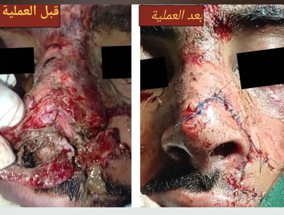 نتيجة اصلاح جرح الأنف 10