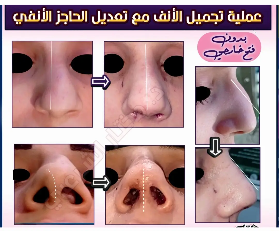نتيجة تجميل الأنف 2