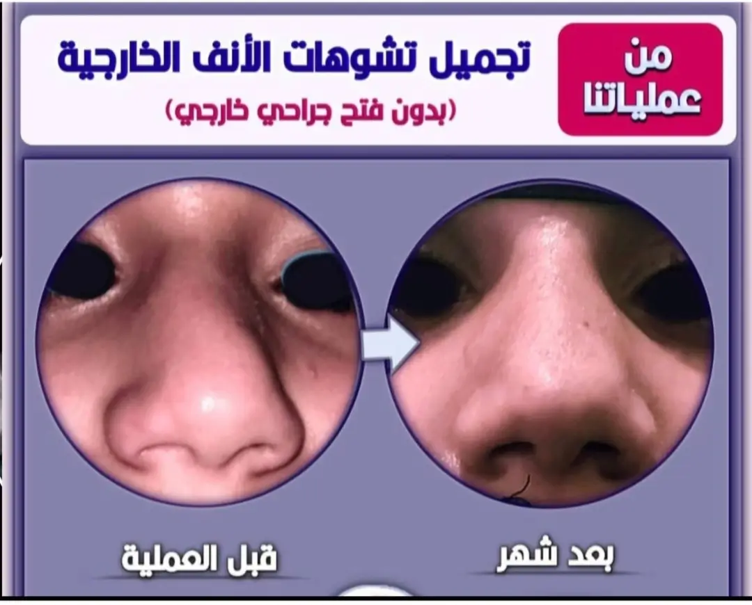 نتيجة تجميل الأنف1 6