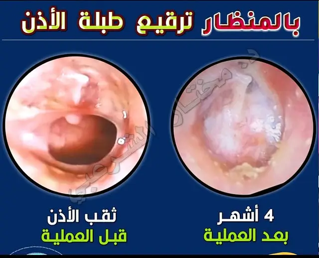 نتيجة ترقيع الطبلة 1